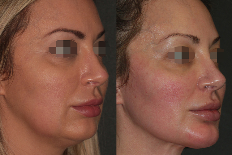 BeautiFill® Before & After