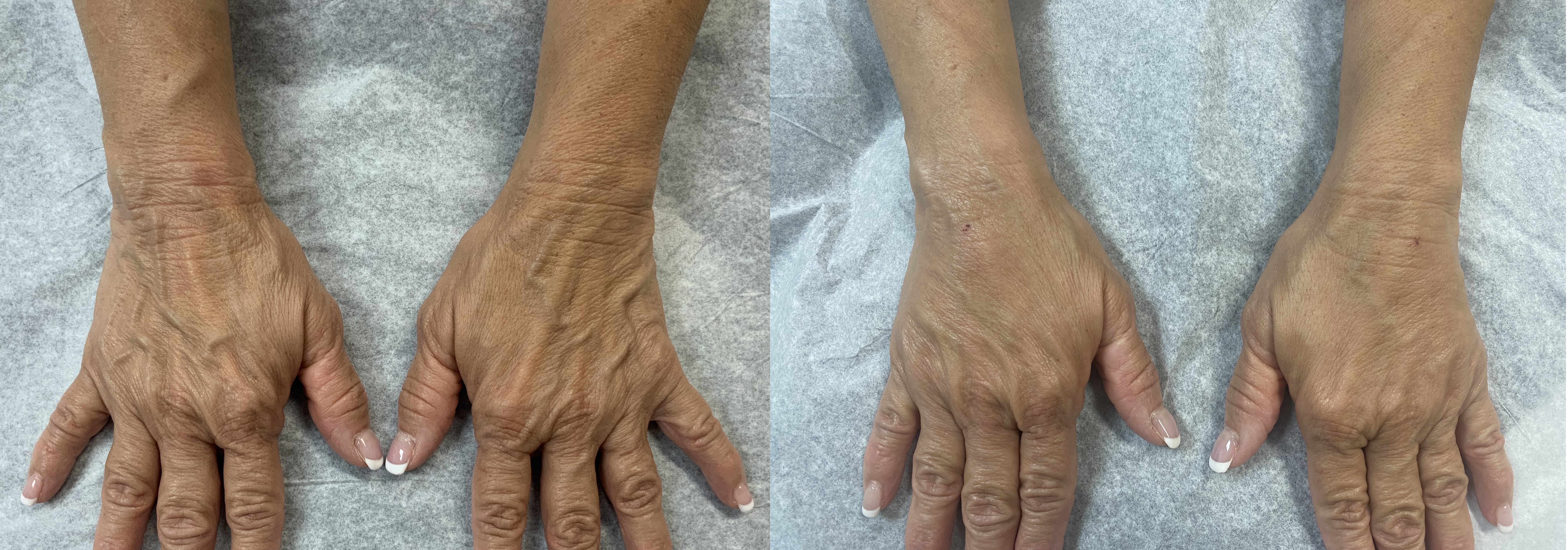 BeautiFill® Autologous Fat Transfer Before and After