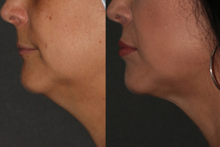 BeautiFill™ Before & After